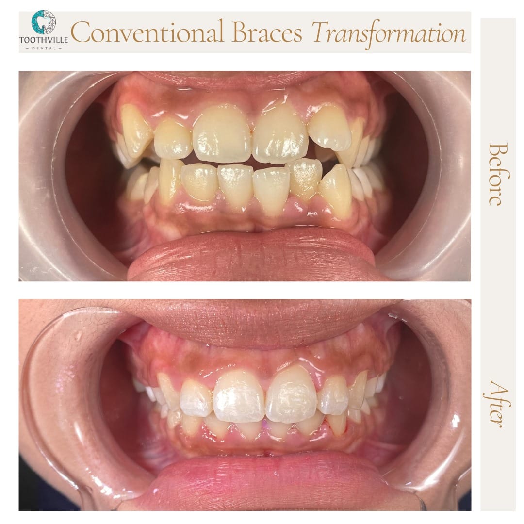 LP - Braces 4 WhatsApp Image 2025-09-22 at 12.37.24 PM (1)