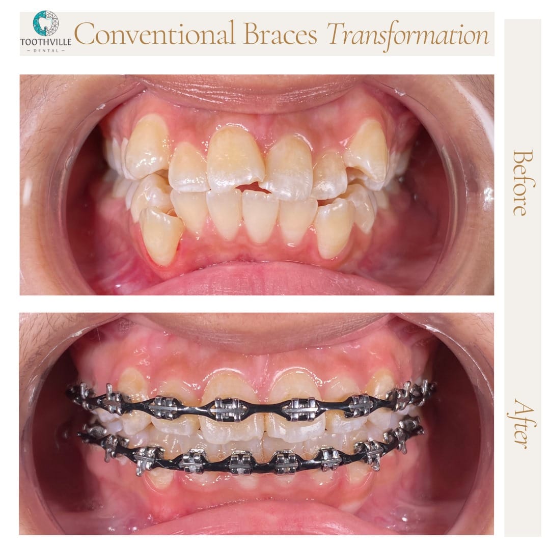 LP - Braces 5 WhatsApp Image 2025-09-22 at 12.37.24 PM